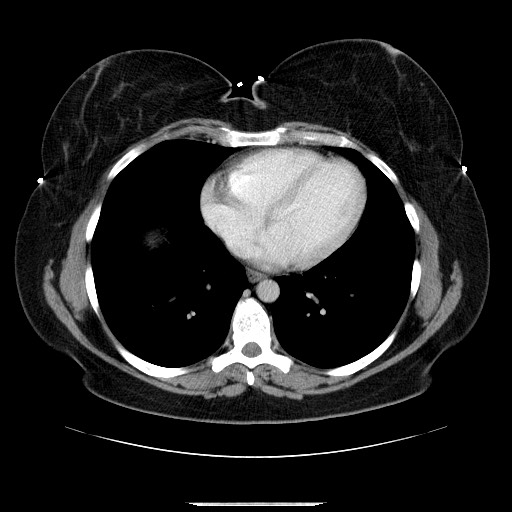 File:Breast cancer pseudocirrhosis after chemotherapy (Radiopaedia 65407-74456 Axial 47).jpg