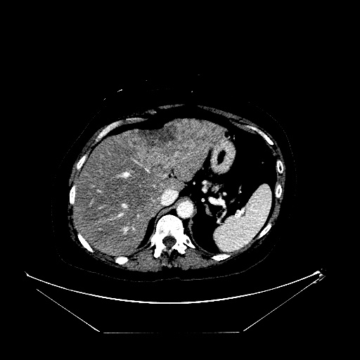 Breast cancer pseudocirrhosis with lobar invovlement (Radiopaedia 81080-94670 Axial liver window 44).jpg
