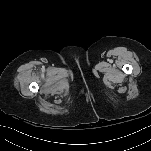 Breast carcinoma with pathological hip fracture (Radiopaedia 60314-67974 B 84).jpg