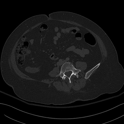 File:Breast carcinoma with pathological hip fracture (Radiopaedia 60314-67993 Axial bone window 7).jpg