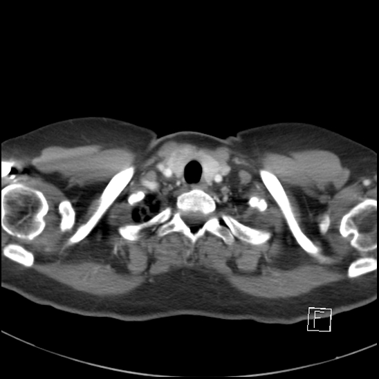 File:Breast metastases from renal cell cancer (Radiopaedia 79220-92225 A 7).jpg