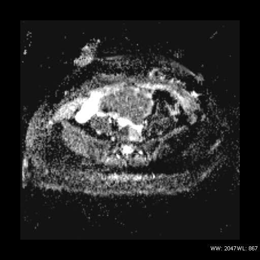 File:Broad ligament fibroid (Radiopaedia 49135-54241 Axial ADC 9).jpg