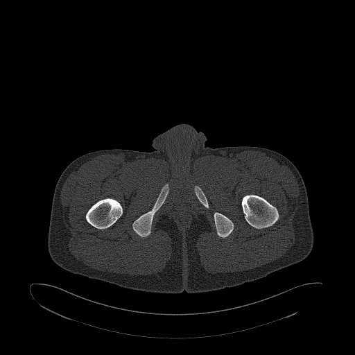 Brodie abscess- femoral neck (Radiopaedia 53862-59966 Axial bone window 211).jpg
