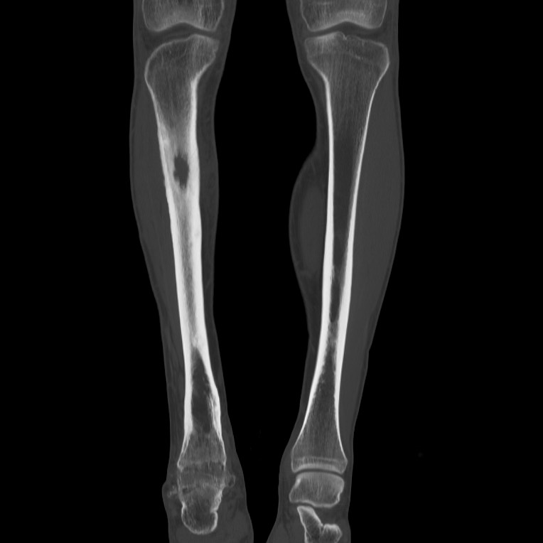 Brodie abscess - tibia (Radiopaedia 66028-75204 Coronal bone window 16).jpg
