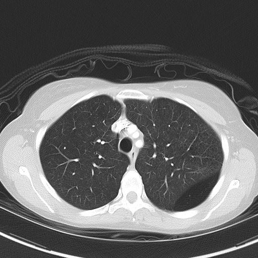 File:Bronchial atresia (Radiopaedia 73677-84470 Axial lung window 19).jpg