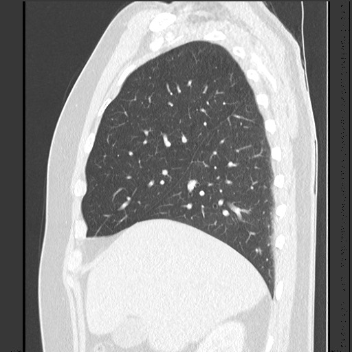 File:Bronchial carcinoid tumor (Radiopaedia 67377-76764 Sagittal lung window 19).jpg