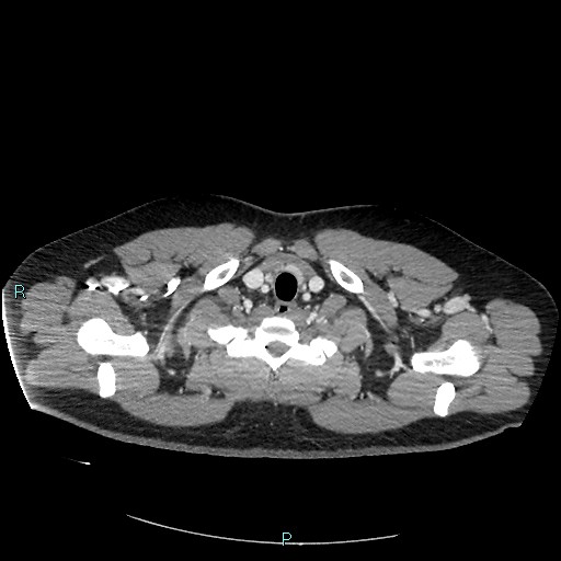 Bronchial carcinoid tumor (Radiopaedia 78272-90875 A 13).jpg
