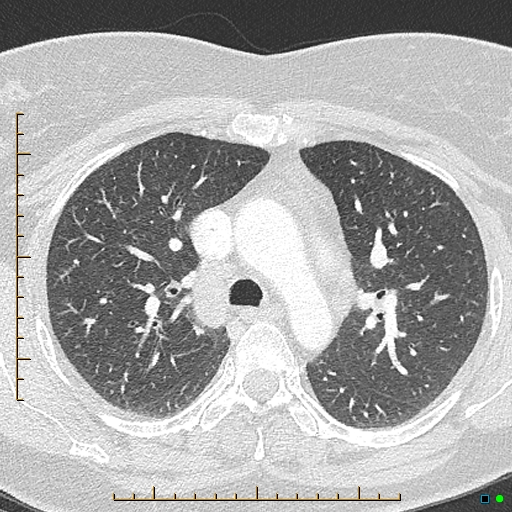 Bronchial diverticula (Radiopaedia 79512-92676 Axial lung window 61).jpg