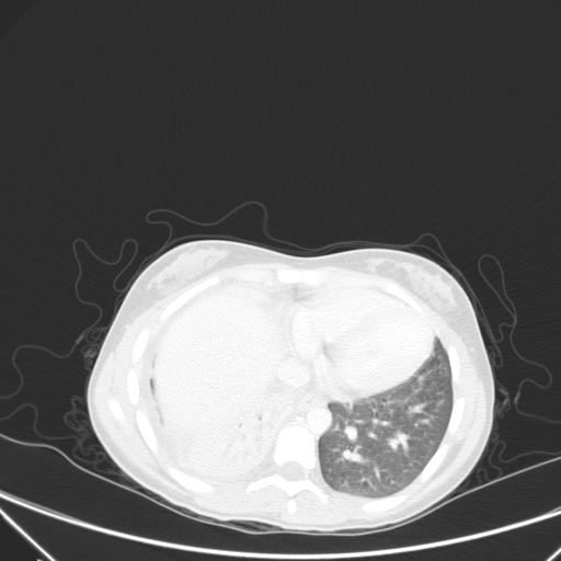 Bronchial mucoepidermoid carcinoma (Radiopaedia 57023-63895 Axial lung window 81).jpg