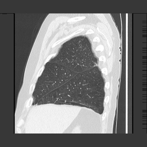 Bronchial stenosis - lung transplant (Radiopaedia 73133-83848 Sagittal lung window 16).jpg