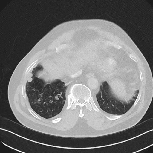 Bronchiectasis (Radiopaedia 39385-41666 Axial lung window 52).png