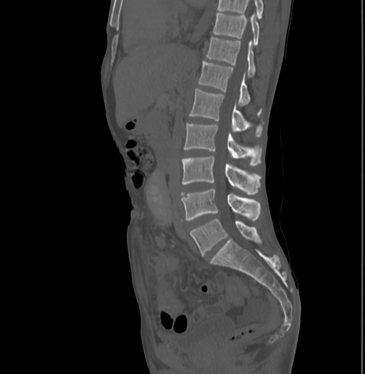 Bronchiectasis in Crohn disease (Radiopaedia 60311-67977 Sagittal bone window 120).jpg
