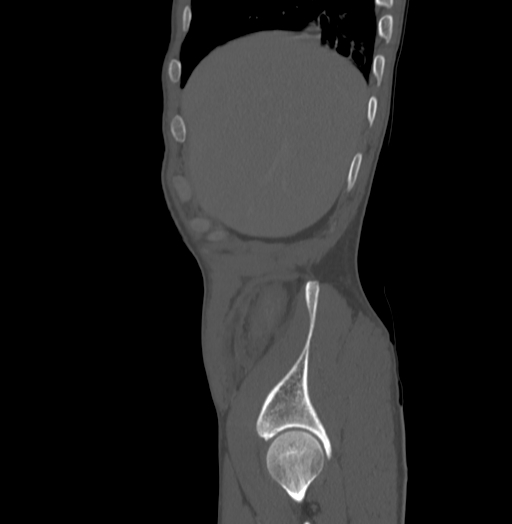 Bronchiectasis in Crohn disease (Radiopaedia 60311-67977 Sagittal bone window 7).jpg