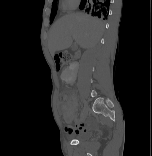 File:Bronchiectasis in Crohn disease (Radiopaedia 60311-67977 Sagittal bone window 78).jpg
