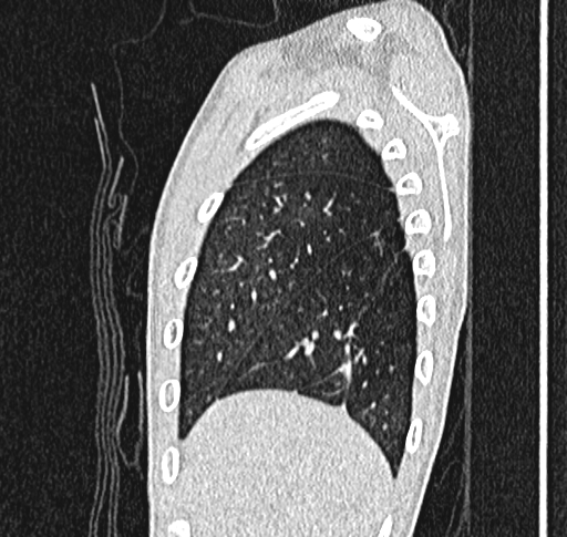 File:Bronchiolitis obliterans (Radiopaedia 71538-81897 Sagittal lung window 8).jpg