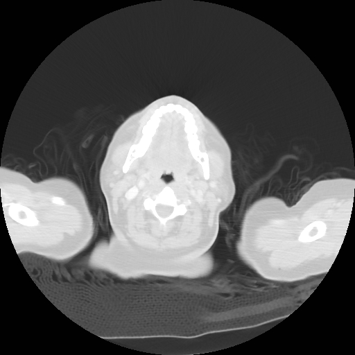 Bronchogenic carcinoma (Radiopaedia 73497-84262 Axial lung window 2).jpg
