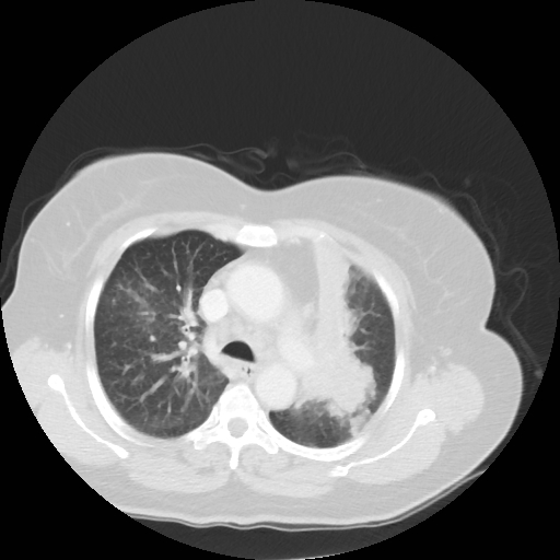 Bronchogenic carcinoma (Radiopaedia 73497-84262 Axial lung window 28).jpg
