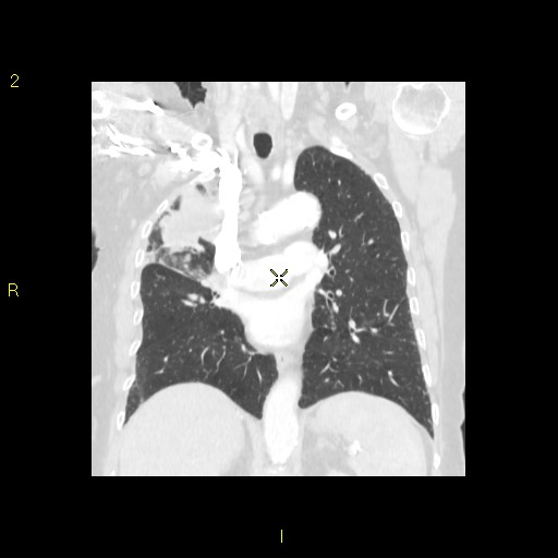 File:Bronchogenic carcinoma as an incidental finding (Radiopaedia 16453-16130 Coronal lung window 28).jpg