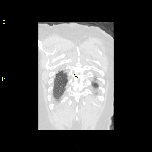 File:Bronchogenic carcinoma as an incidental finding (Radiopaedia 16453-16130 Coronal lung window 43).jpg