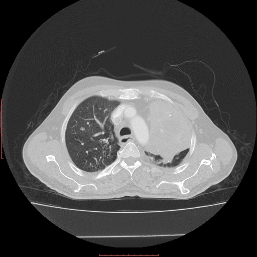 File:Bronchogenic carcinoma with left atrial large deposit - T4N3M1a (Radiopaedia 42316-45428 Axial lung window 9).jpg