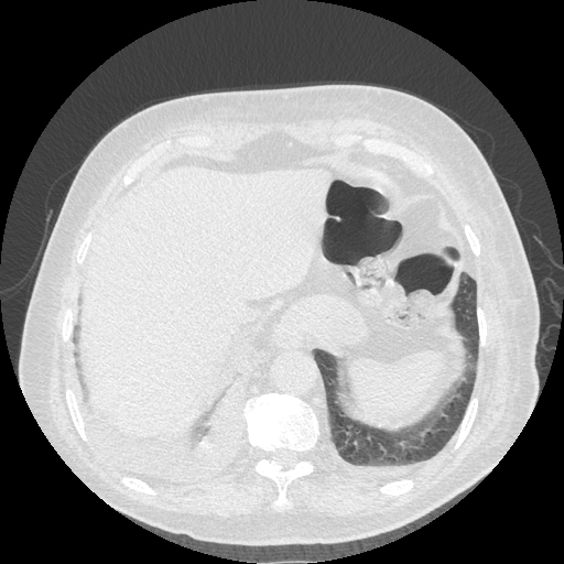 Bronchogenic carcinoma with metastatic lymphadenopathy (Radiopaedia 37671-39569 Axial lung window 47).jpg