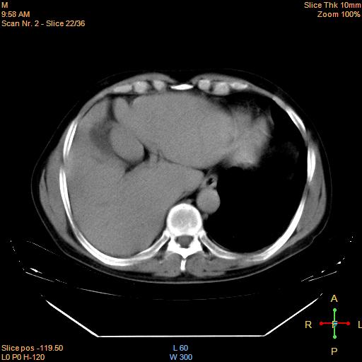File:Bronchogenic carcinoma with superior vena caval invasion (Radiopaedia 22378-22406 Mediastinal window 19).jpg