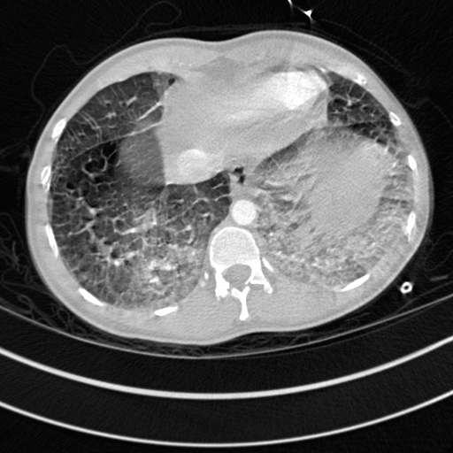 Bronchogenic cyst (Radiopaedia 77801-90071 Axial lung window 73).jpg