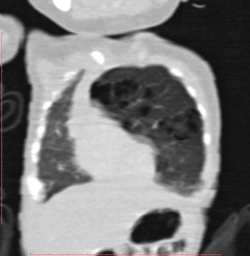 Bronchogenic cyst (Radiopaedia 78599-91409 Coronal lung window 54).jpg