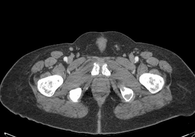 Brown tumors compressing the spinal cord (Radiopaedia 68442-77988 E 132).jpg