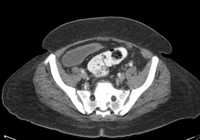 File:Brown tumors compressing the spinal cord (Radiopaedia 68442-77988 E 98).jpg