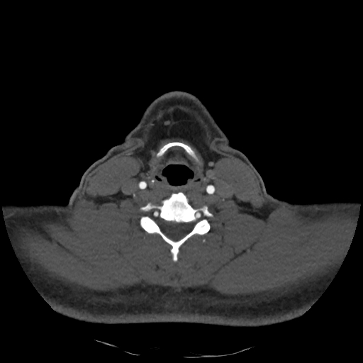 Buccal fat pad arteriovenous malformation (Radiopaedia 70936-81144 A 76).jpg