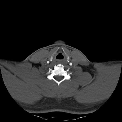Buccal fat pad arteriovenous malformation (Radiopaedia 70936-81144 A 80).jpg