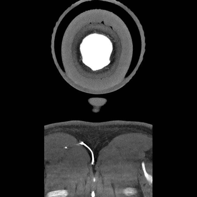 Buccal fat pad arteriovenous malformation (Radiopaedia 70936-81144 B 61).jpg