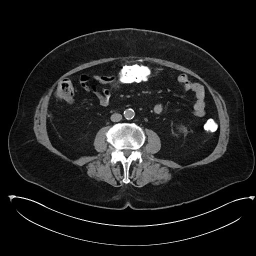 Buried bumper syndrome - gastrostomy tube (Radiopaedia 63843-72577 Axial Inject 61).jpg