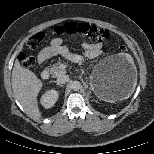 Burned-out testicular seminoma - retroperitoneal nodal metastases (Radiopaedia 62872-71245 A 25).jpg