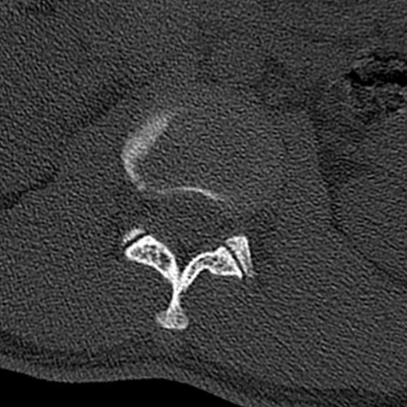 Burst fracture (Radiopaedia 53373-59357 Axial bone window 16).jpg