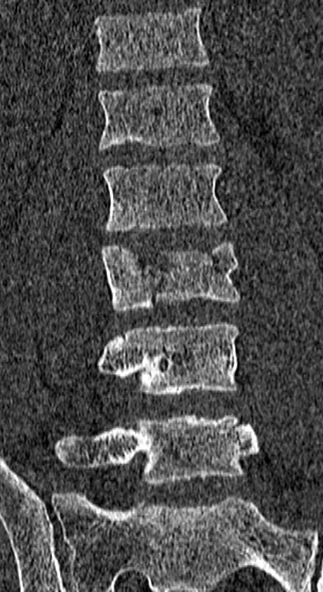 File:Burst fracture (Radiopaedia 53373-59357 Coronal bone window 36).jpg