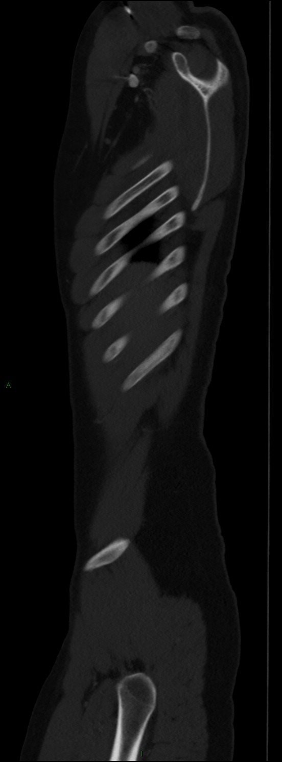 Burst fracture (Radiopaedia 83168-97542 Sagittal bone window 25).jpg