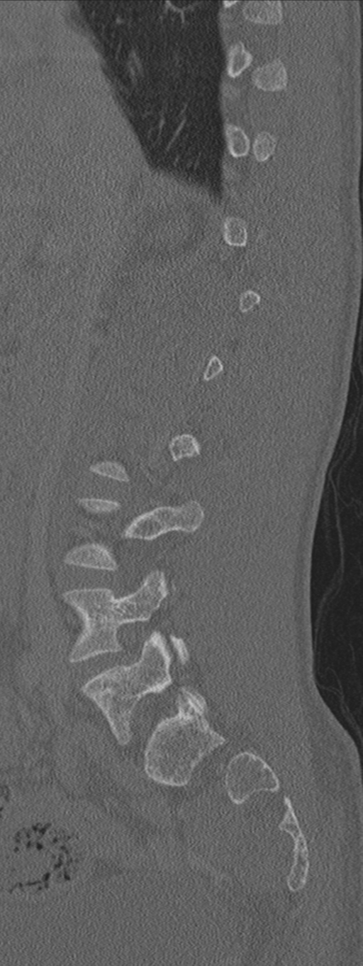Burst fracture - T12 with conus compression (Radiopaedia 56825-63647 Sagittal bone window 58).png
