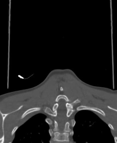 Butterfly vertebra (Radiopaedia 77903-90209 Coronal bone window 85).jpg