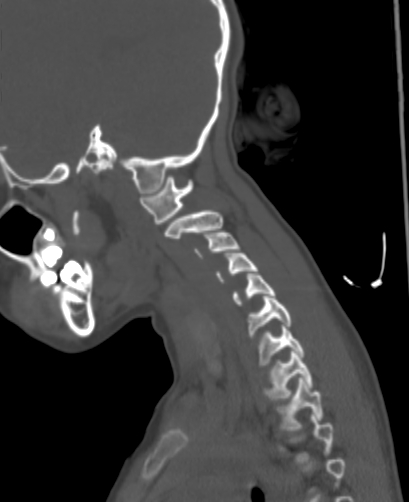 Butterfly vertebra (Radiopaedia 77903-90209 Sagittal bone window 80).jpg