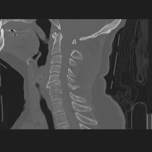 C2 fracture (Radiopaedia 34091-35341 Sagittal bone window 39).png