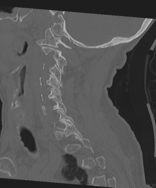 C2 fracture with vertebral artery dissection (Radiopaedia 37378-39199 Sagittal bone window 28).png