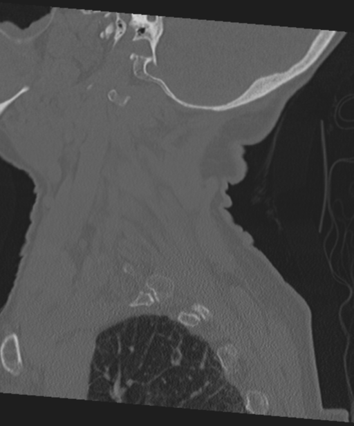 C2 fracture with vertebral artery dissection (Radiopaedia 37378-39199 Sagittal bone window 62).png