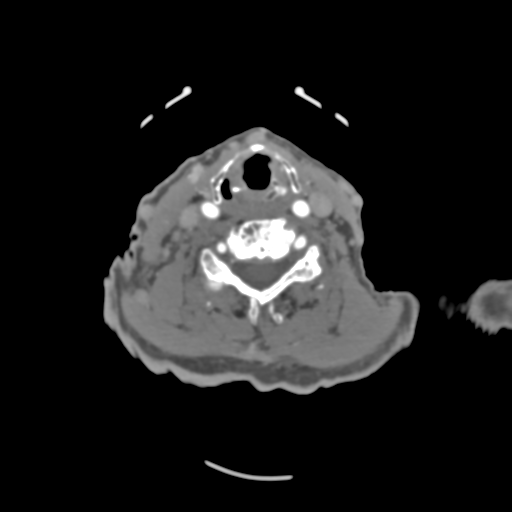 File:C2 fracture with vertebral artery dissection (Radiopaedia 37378-39200 A 112).png