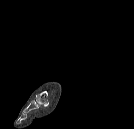 Calcaneal fracture - Sanders type 4 (Radiopaedia 90179-107370 Sagittal bone window 11).jpg