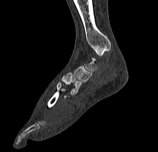 Calcaneal fracture - Sanders type 4 (Radiopaedia 90179-107370 Sagittal bone window 35).jpg