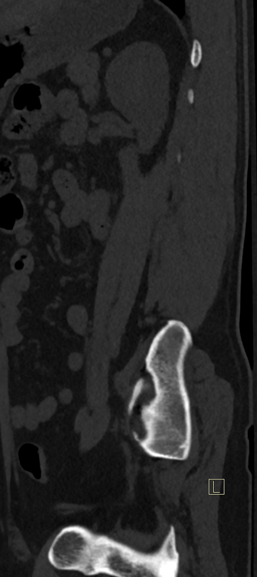 Calcaneal fractures with associated L2 burst fracture (Radiopaedia 71671-82493 Sagittal bone window 3).jpg