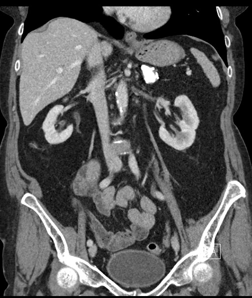 Calcified adrenal glands and Spigelian hernia (Radiopaedia 49741-54988 B 57).jpg