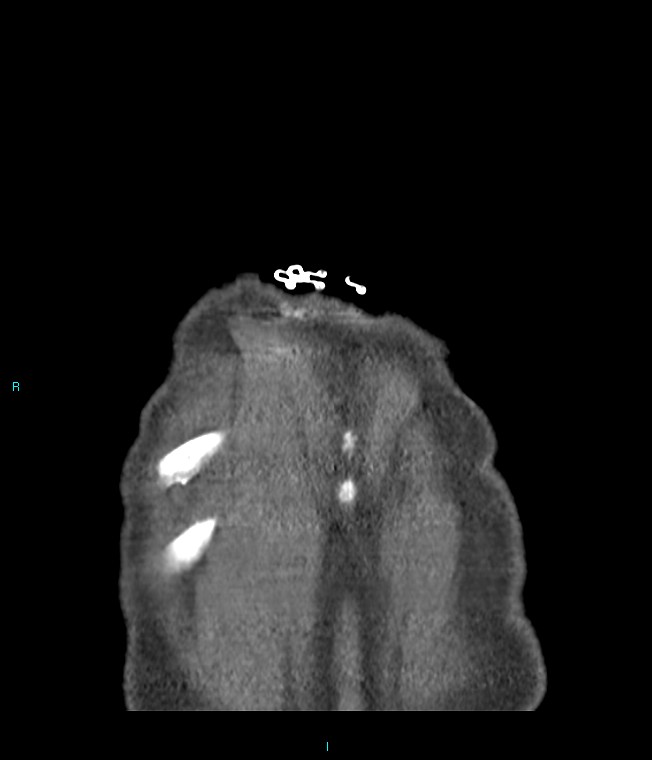 Calcified cerebral emboli from left ventricular thrombus (Radiopaedia 84420-99760 Coronal C+ CTPA 3).jpg